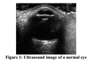 The Middle Layer Appeared Anechoic Anterior Chamber Of Eye Lens Cortex And Nucleus Vitreous Were Other Echoic Structures Including The Middle Layer Appeared Anechoic Anterior Chamber Of Eye Lens Cortex And Nucleus Vitreous Were Other Echoic Structures Including