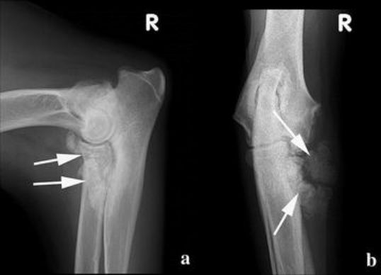 A chondroblastic of the coronoid process mimicking a