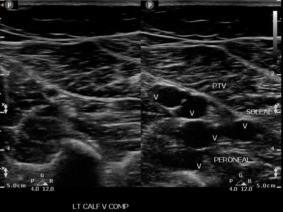 Venous Ultrasound HandsOn Training Vascular HandsOn Education RVS