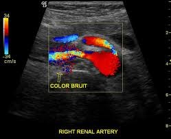 Renal Artery and Mesenteric Duplex 