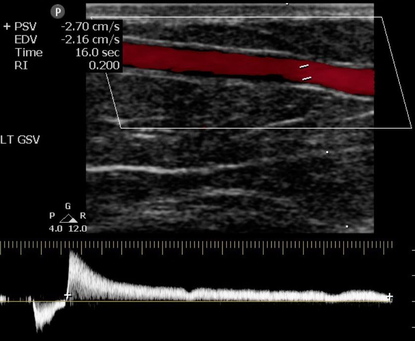 venous duplex venous duplex