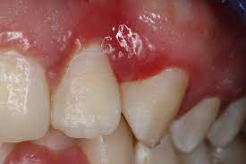 Gingivitis en niños y adolescentes