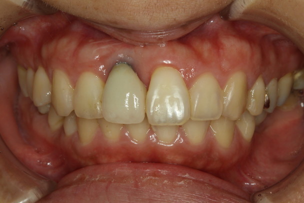 前歯のインプラントの歯茎が下がった