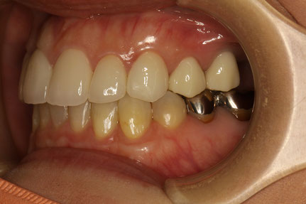 歯科治療ブログ　ホームホワイトニングについて