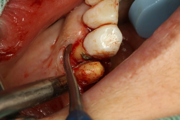 歯茎の中の歯石