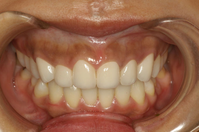 これで解決。歯並びや歯の形ををきれいに治す歯科治療法とは