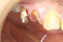 土台ごとはずれた差し歯を抜かずに残したい方の歯科治療