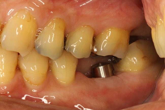 歯の無い所にインプラントを入れる歯科治療の注意点
