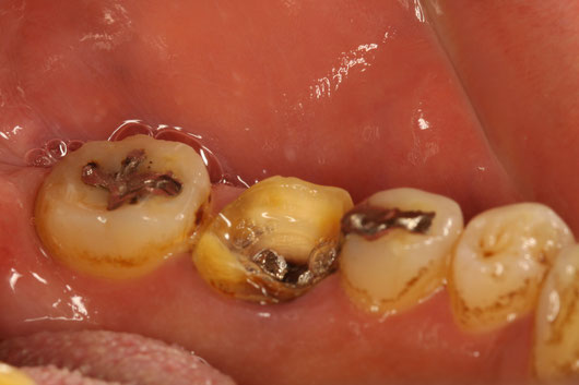 歯を抜かない歯科治療　外れてしまった差し歯の中が虫歯になっても残す方法