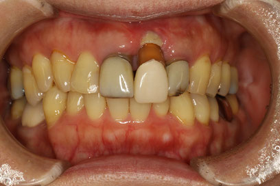 前歯の歯茎の見た目を改善する歯科治療