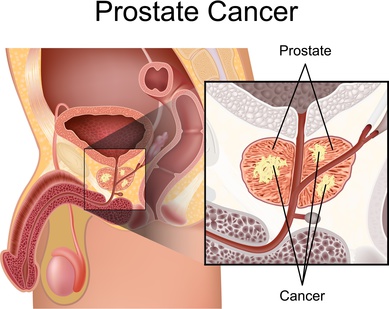 Prostatakrebs, Ursachen des Prostatakrebses