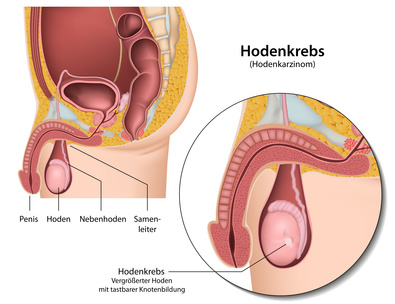 Hosenkrebs erkennen, Lokalisation des Hosentumors