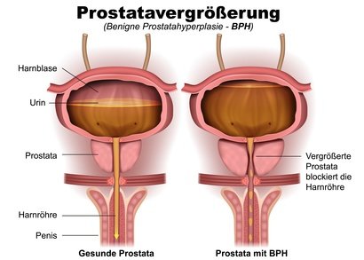 prostataadenom behandlung medikamente