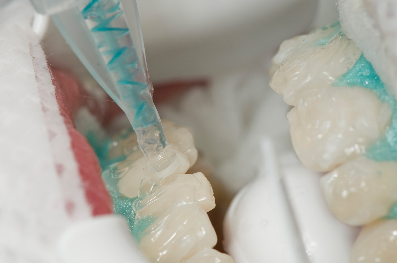 Strahlend Weisse Zahne Durch Zahnaufhellung Prophylaxe Zahnreinigung Zahnersatz Zahnarzt Koln Suelz Klettenberg