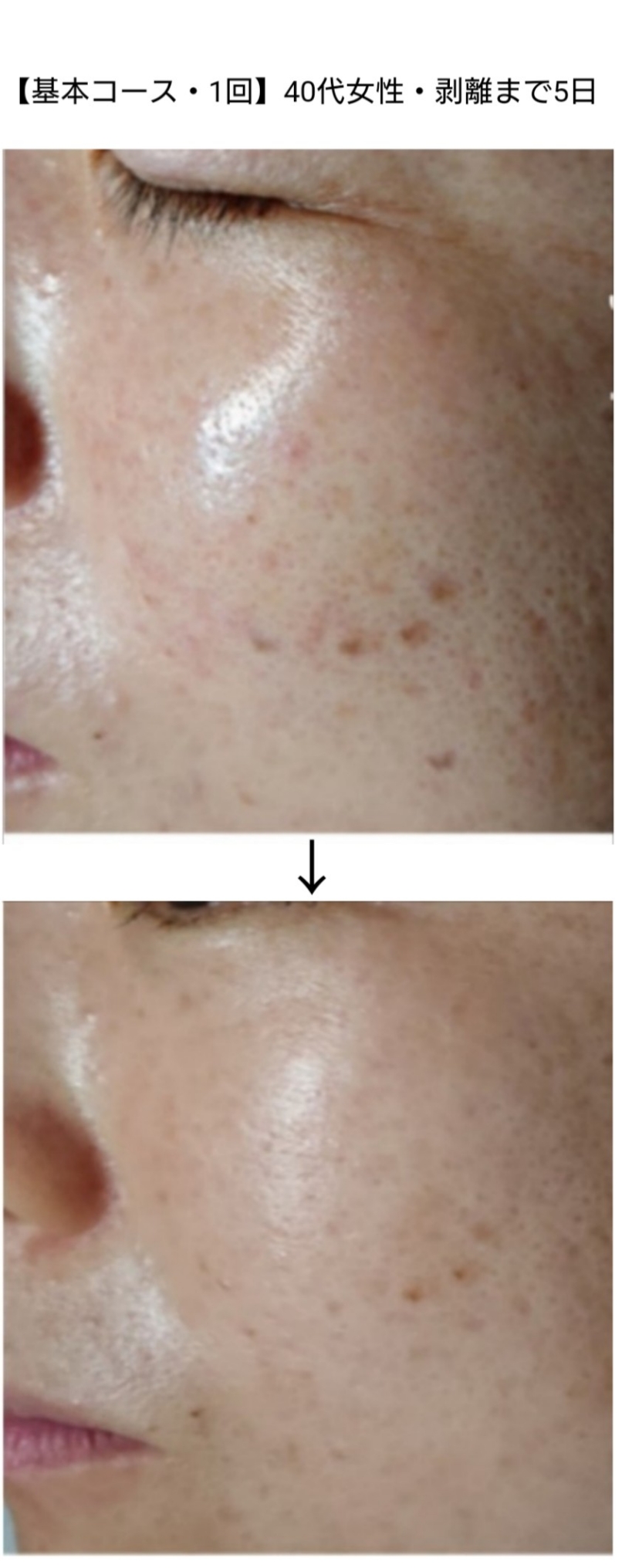 シミに悩む全ての方に シミデトックス 栃木県栃木市エステサロン チューラ