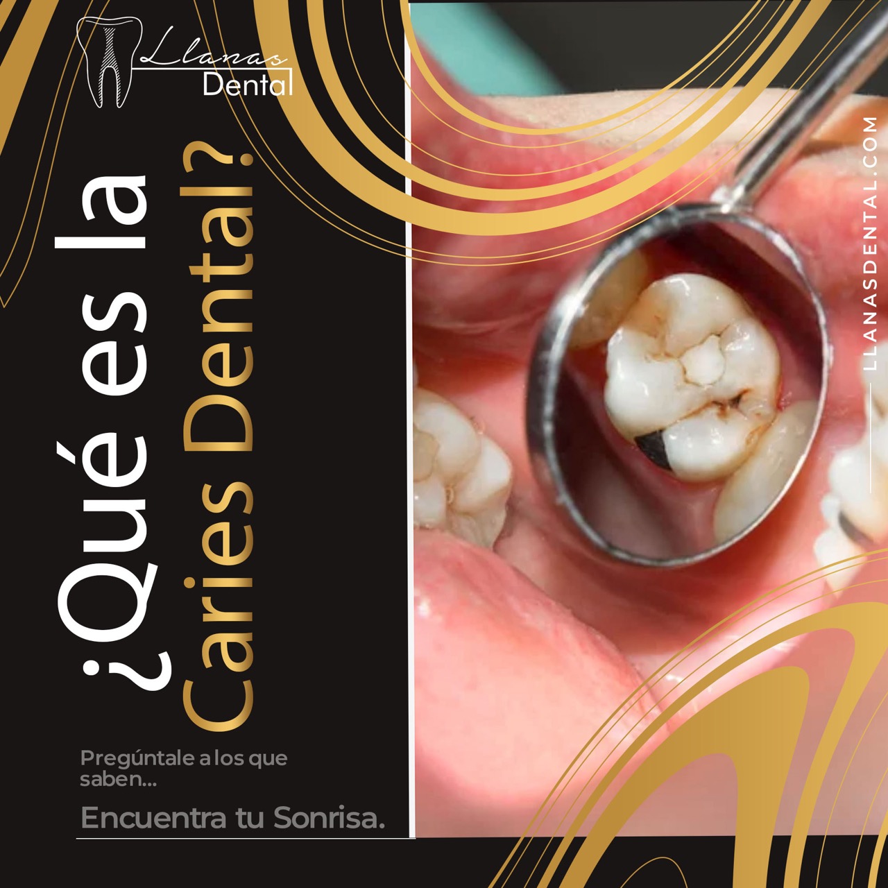 ¿Qué es la Caries dental?