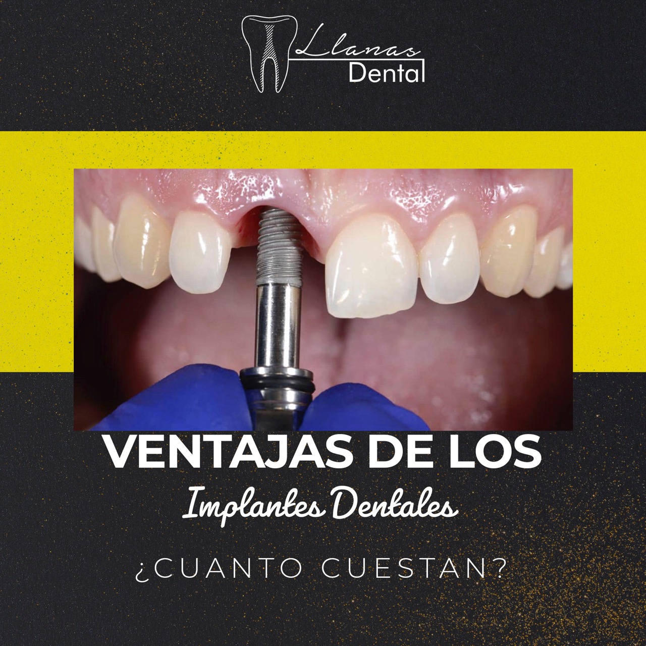 Implantes Dentales Dentistas en Ciudad Juárez