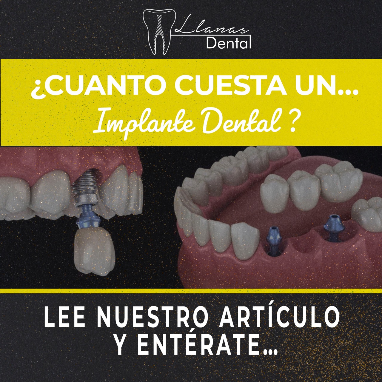 Costo de implantes dentales en Ciudad Juarez a 2024