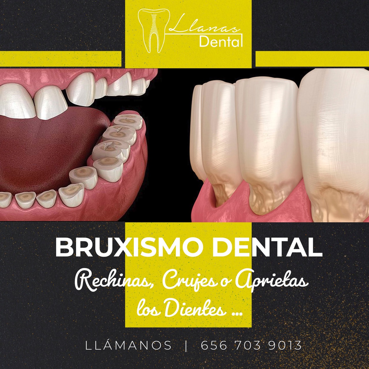 bruxismo-dental-ciudad-juarez
