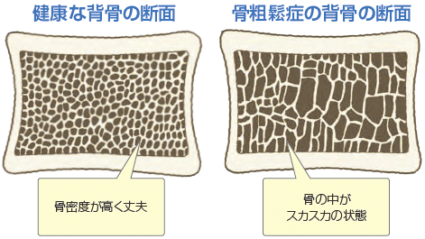 骨粗鬆症予防のコツ Lino プラスリノ 骨粗鬆症予防のコツ Lino プラスリノ