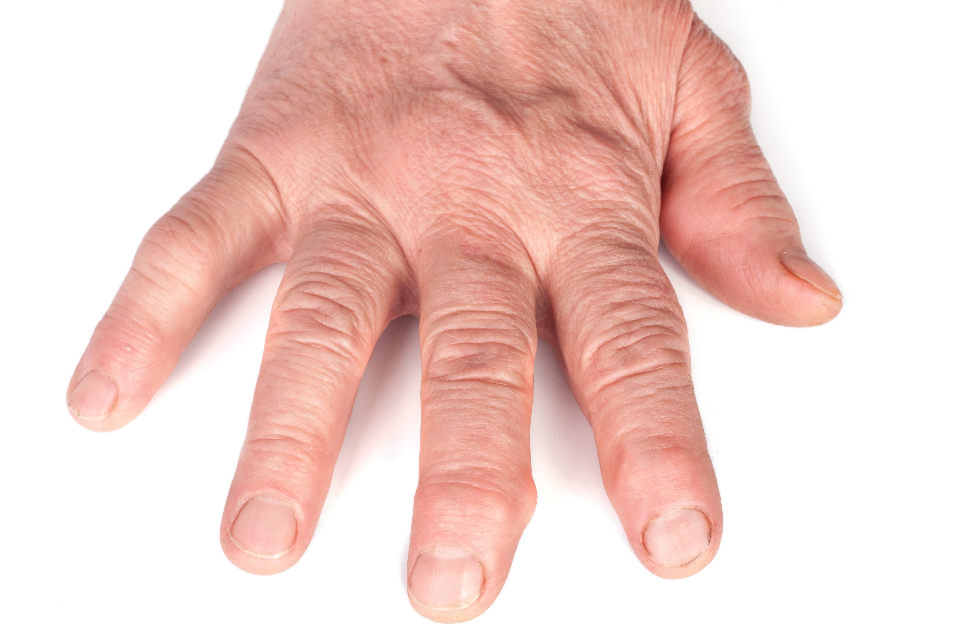 Arthrose: Fingergelenk behandeln - Mikroinvasive Therapie Bern