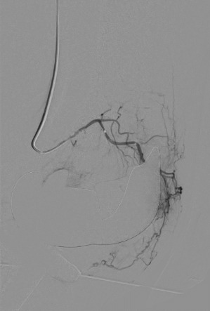Röntgenbild vor Gelenk-Embolisation Mikrogefässe