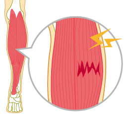 肉離れ 鶯谷駅から徒歩5分 アスリートが集まる台東区の台東すこやか整骨院