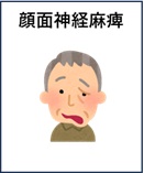 顔面神経麻痺