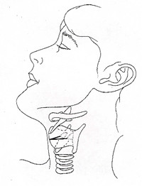 喉頭摘出手術　喉頭の位置