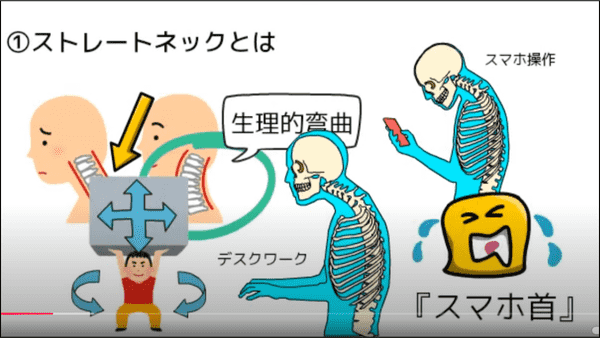 ストレートネックとVDT症候群（スマホ病）