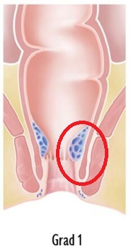 Hämorrhoiden Grad 1: Vergrösserung im Analkanal, nicht sichtbar