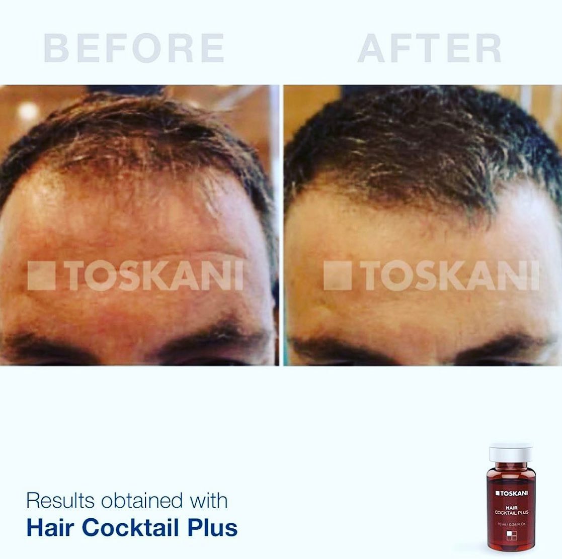 Meso Hair - Mesotherapie gegen Haarausfall - Alopezia - Beautiful Style ...