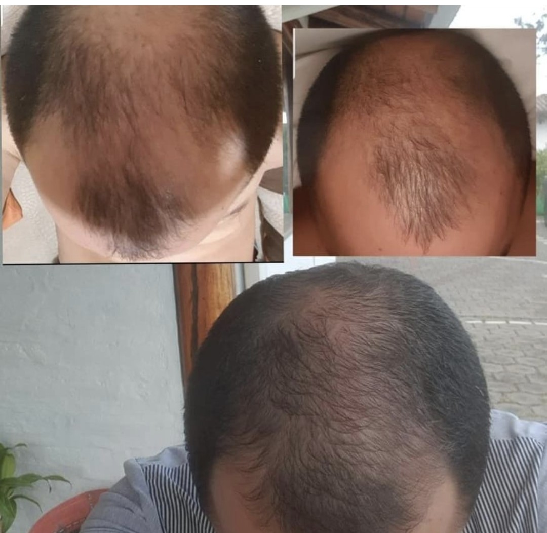 Meso Hair - Mesotherapie gegen Haarausfall - Alopezia - Beautiful Style ...