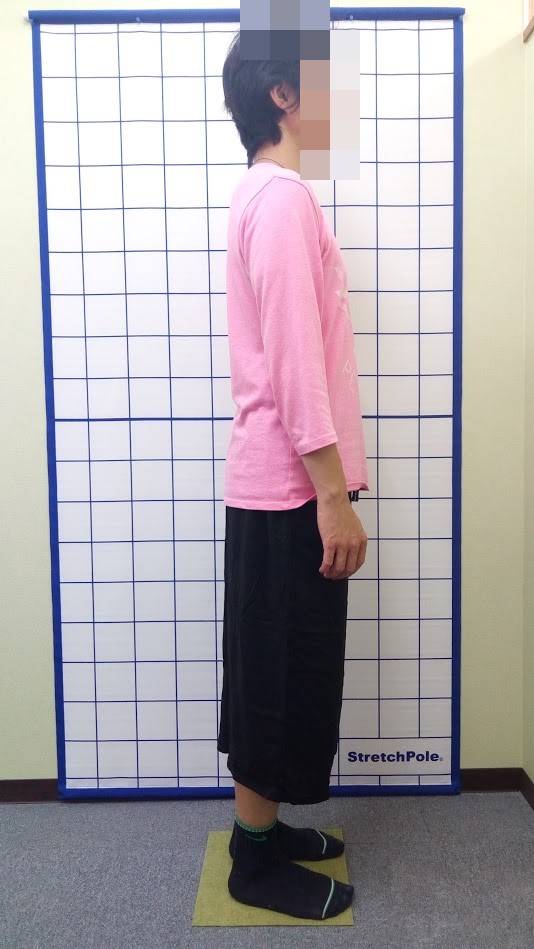ギックリ腰 腰痛 姿勢改善 治療前