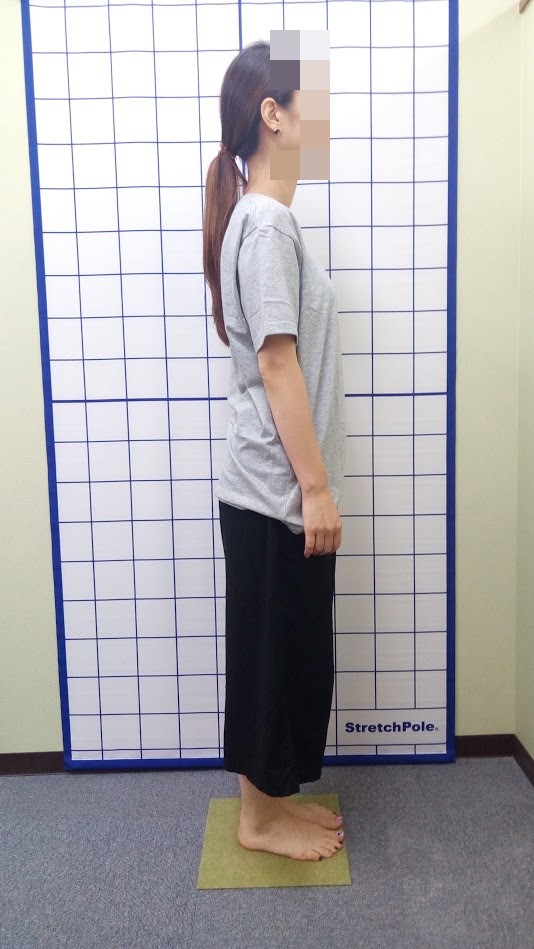 首痛 肩痛 腰痛 頭痛 自律神経 姿勢改善 治療前