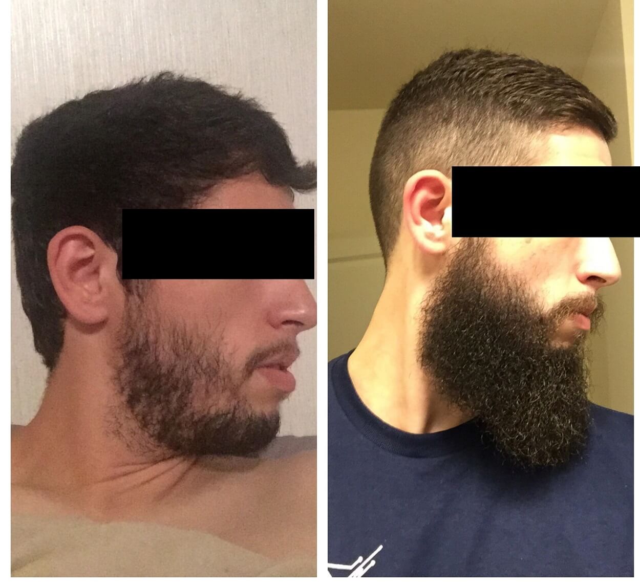 como engrosar la barba rapidamente minoxidil aceite biotina