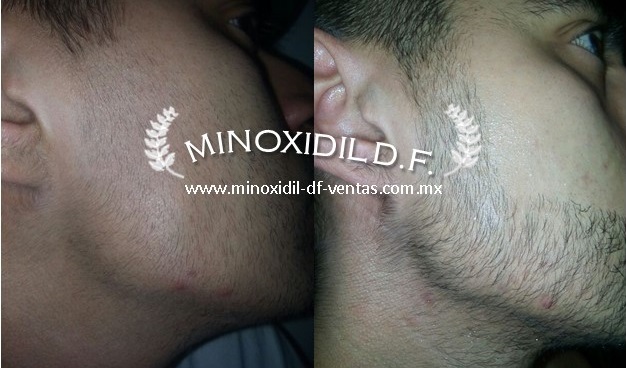 Minoxidil para hacer crecer la barba.