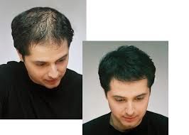 minoxidil para alopecia temporal fluvia