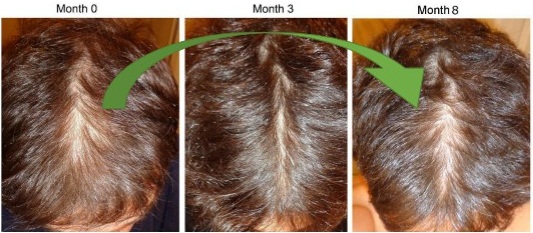 Shedding: Efecto secundario al aplicar minoxidil.
