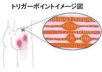 筋の中に出来た硬結が引き起す症状