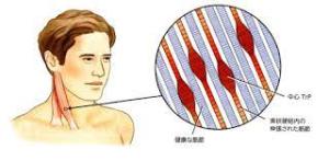 首筋に出来た筋の硬結、ﾏﾆﾋﾟｭﾚｰｼｮﾝで緩める必要があります