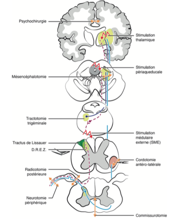 Anatomie de la douleur Neurochirurgien Marseille