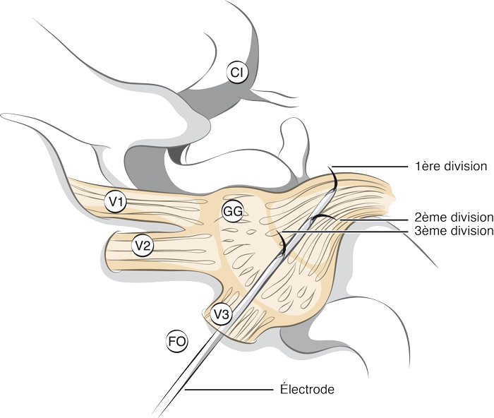 Thermocoagulation du ganglion de Gasser