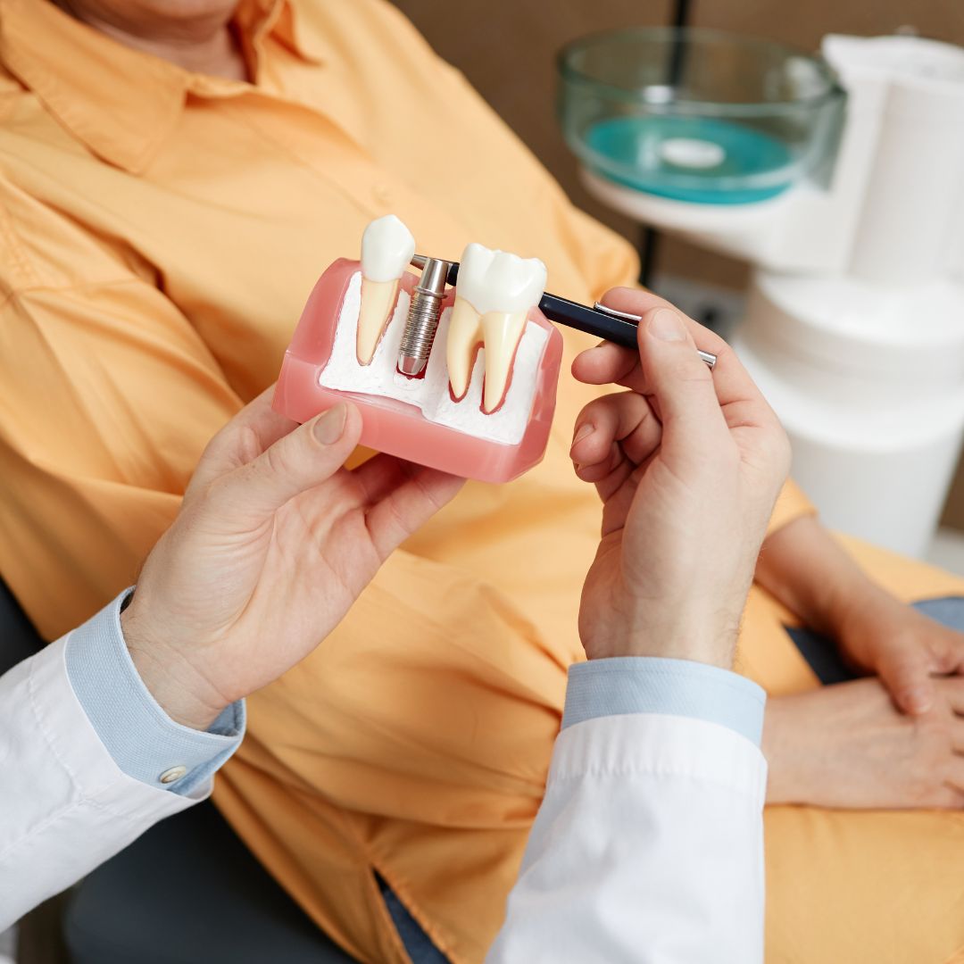 ¿Cómo son los implantes dentales? Entender el procedimiento