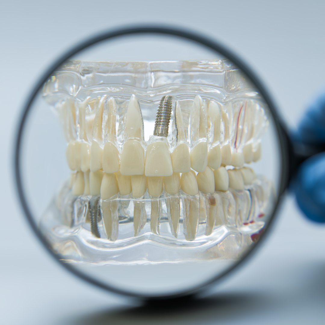 ¿En qué casos no se recomienda un implante dental?