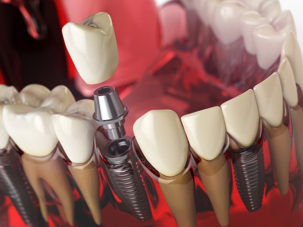 ¿Qué hacer si un implante dental falla?