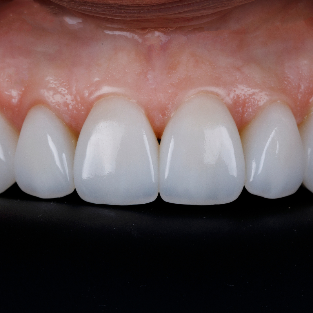 Mitos y verdades sobre las carillas dentales