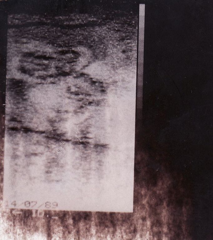 Cristiana und Michela pränatal; Ultraschall vom 14.7.1989 