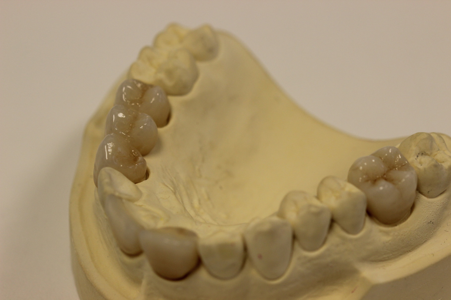 Brucken Fur Fehlende Zahne Ihre Zahnarzte In Burgdorf Bei Hannover Prophylaxe Vollkeramik Implantate