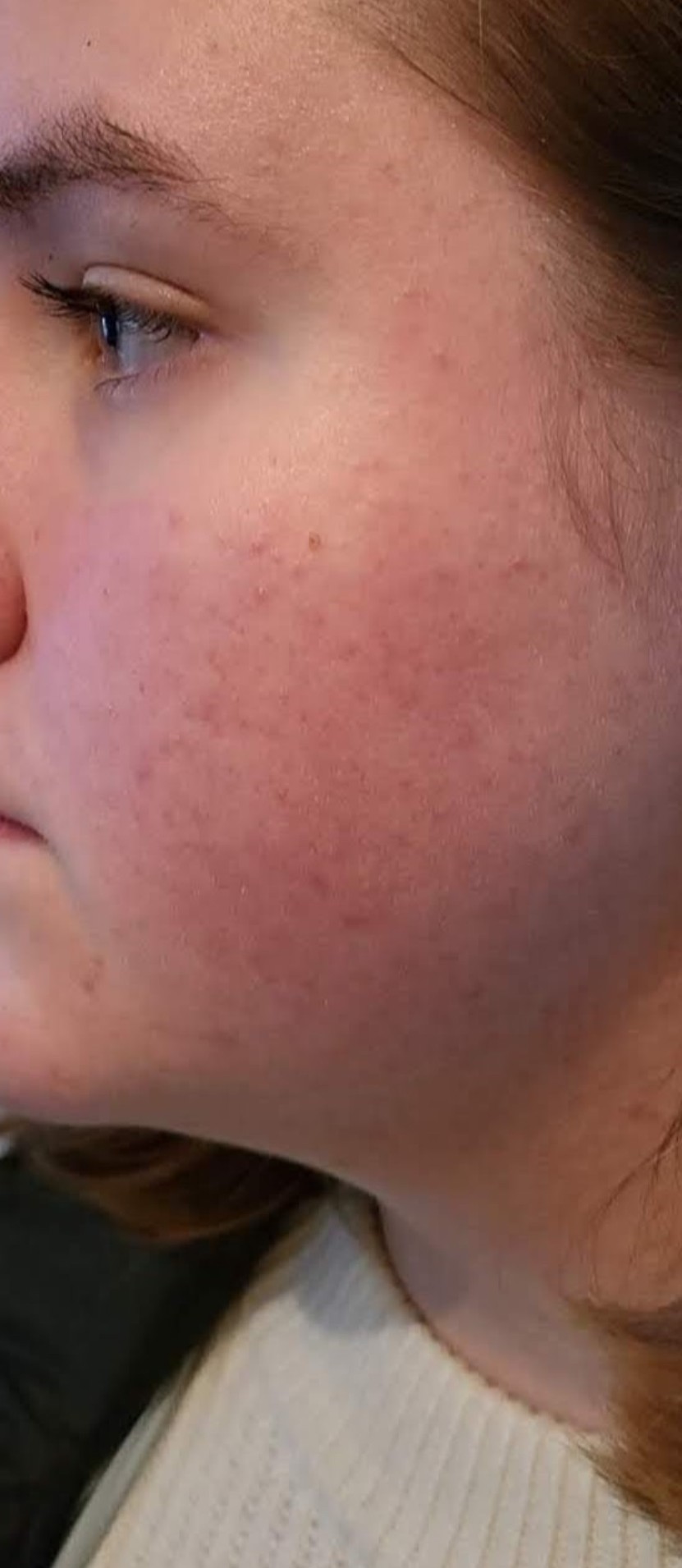 Das Ergebnis nach zwei Behandlungen mit Fruchtsäurepeeling und Heimpflege